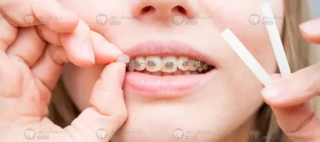 موم ارتودنسی شاخص