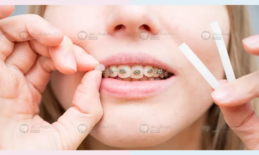 موم ارتودنسی شاخص