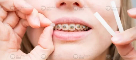 موم ارتودنسی شاخص