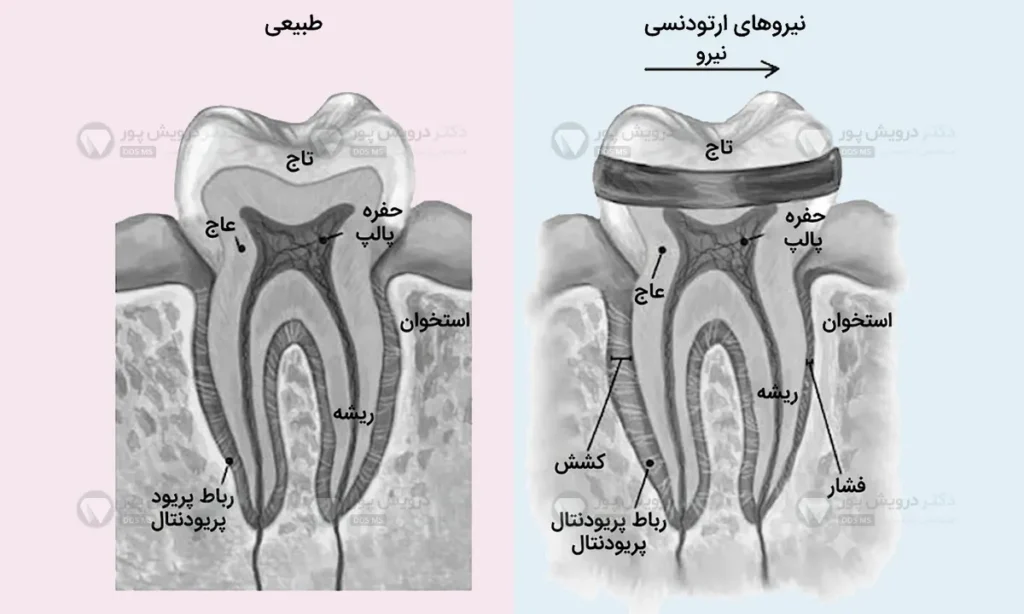 حرکت دندان در ارتودنسی (اینفوگرافی)