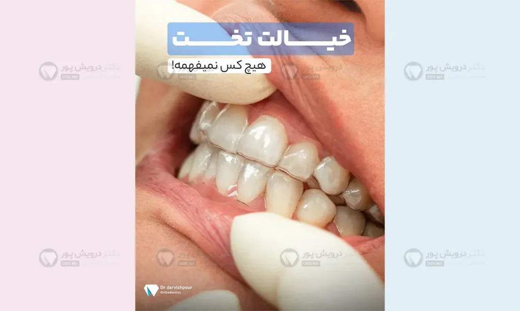 چالش های ارتودنسی نامرئی با الاینرها در جمع