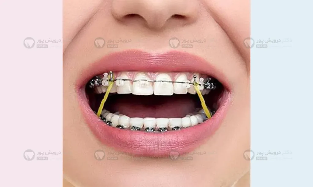 کش ارتودنسی بین فکی