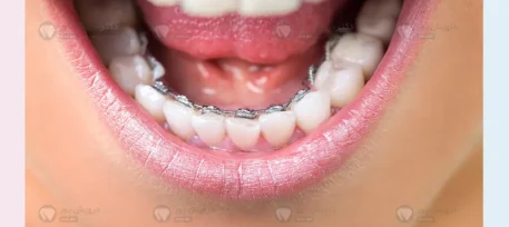 ارتودنسی نامرئی شاخص