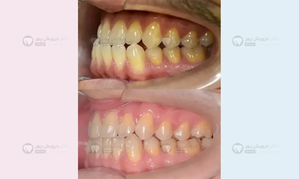 ارتودنسی کاموفلاژ