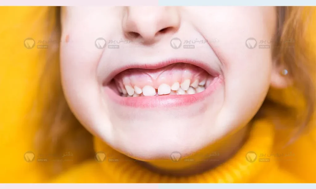 افزایش حجم لثه