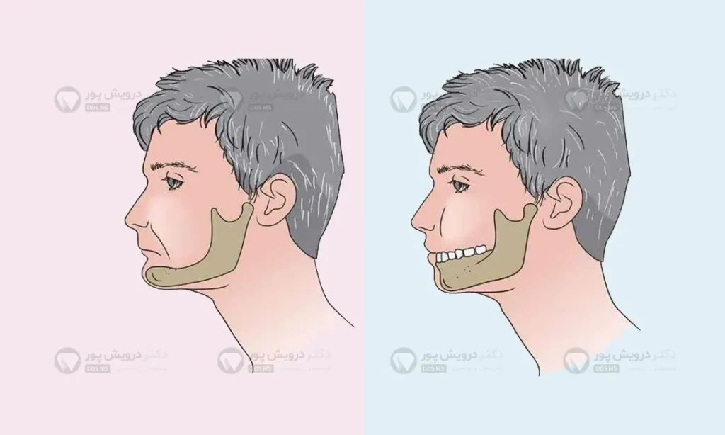 وضعیت صورت با و بدون دندان