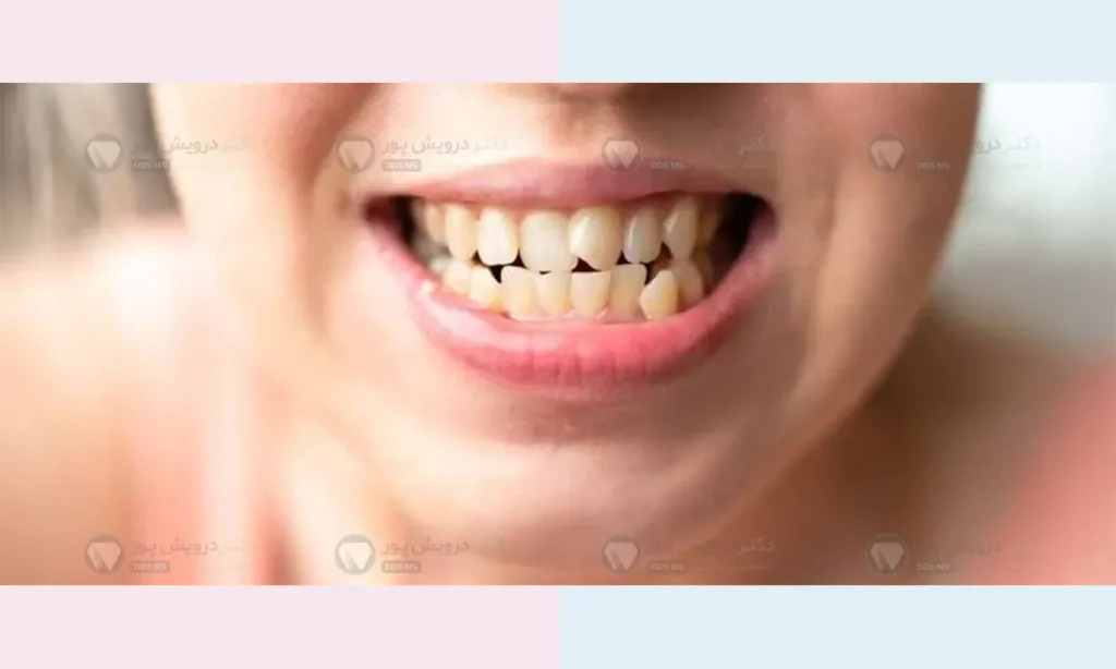 دندان کج جلو را چگونه صاف کنیم شاخص