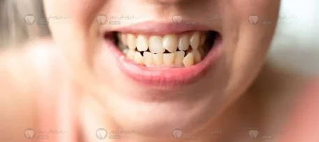 دندان کج جلو را چگونه صاف کنیم شاخص