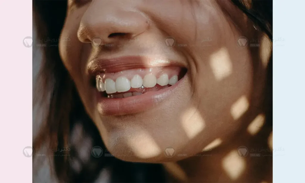 لبخند لثه ای شاخص