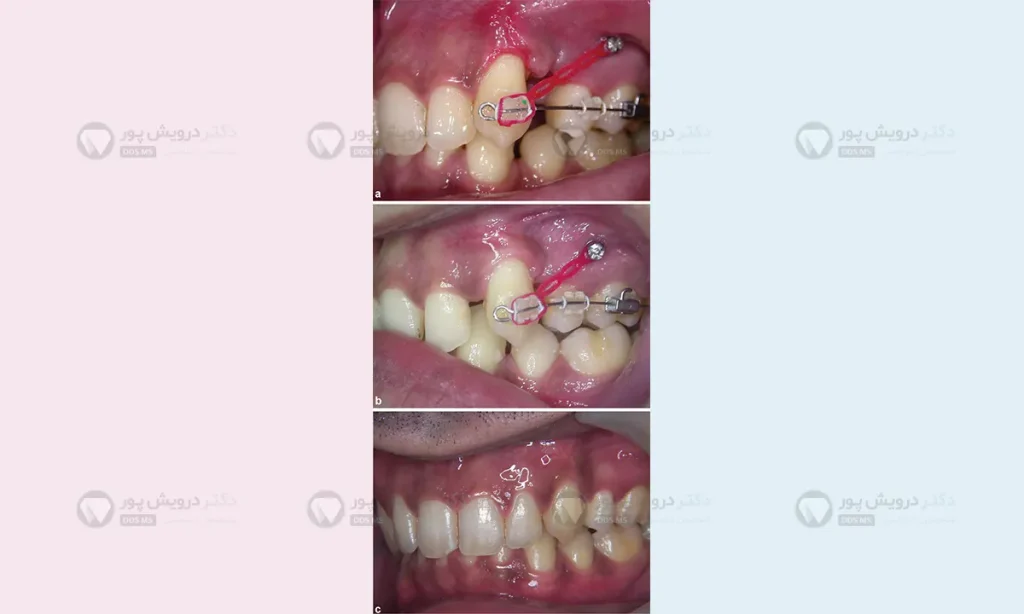 مینی اسکرو با ارتودنسی سرامیکی