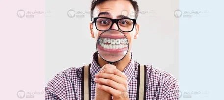 لق شدن دندان در زمان ارتودنسی شاخص